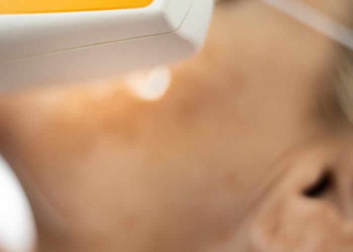 Couperose behandeling